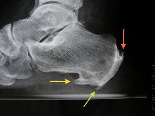 Radiografia che evidenzia spine calcaneari multiple